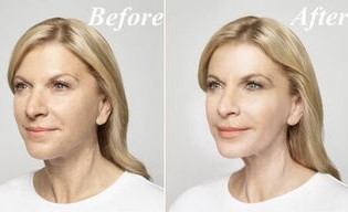 Enne ja pärast kasutamist Goji Cream
