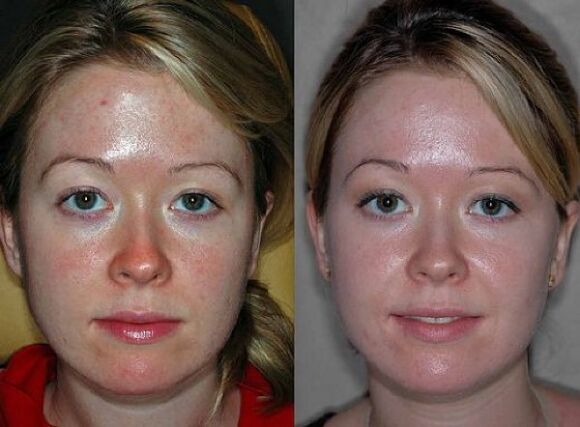 fotod enne ja pärast plasma noorendamise protseduuri