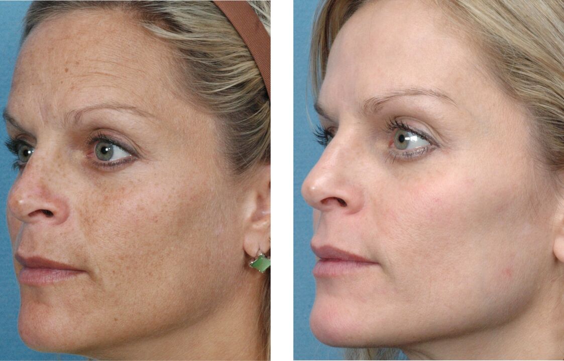 foto enne ja pärast naha noorendamist 1