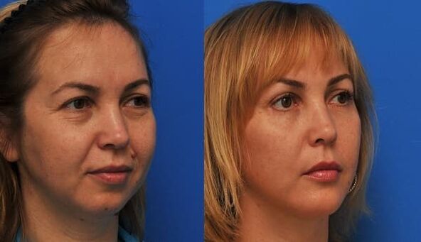 enne ja pärast naha noorendamist pinguldava fotoga 1
