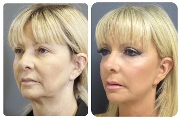 enne ja pärast naha noorendamist pinguldava fotoga 2