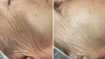 enne ja pärast naha lasernoorendamist