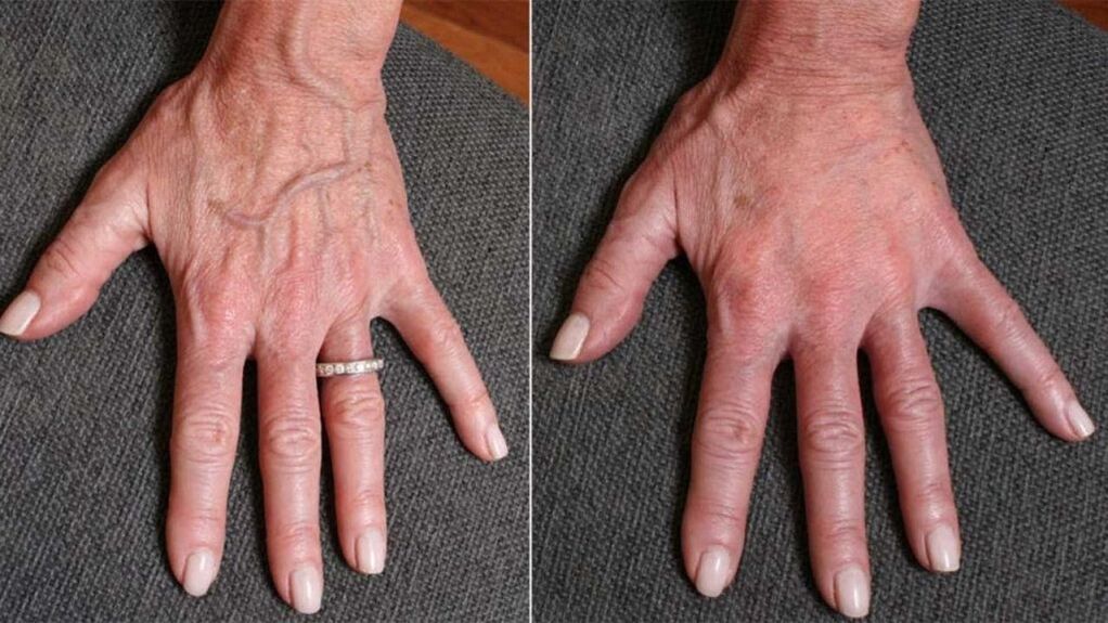 kontuurplastik, käte noorendamise foto 1 enne ja pärast