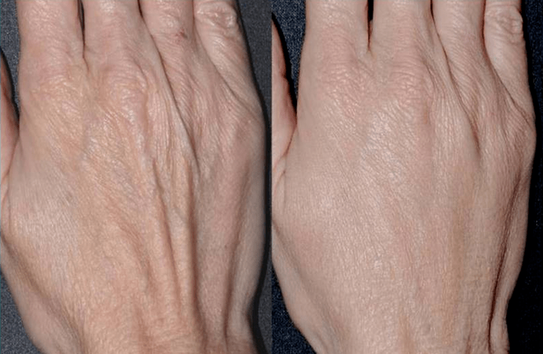 kontuurplastik, käte noorendamise foto 2 enne ja pärast