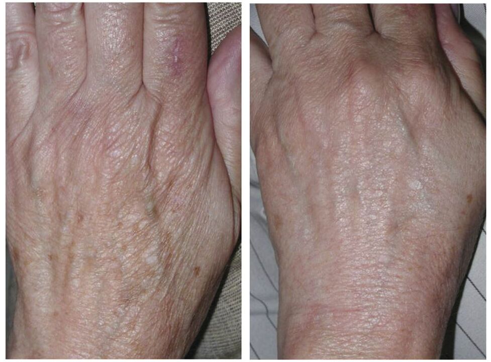 käte noorendamine laseriga enne ja pärast fotosid